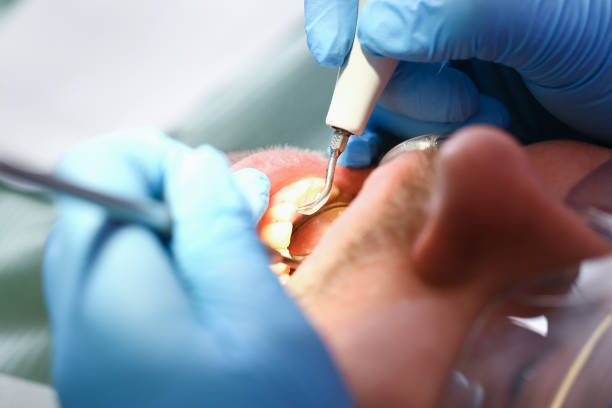 Best Dental Abscess Treatment in Brighton, MI