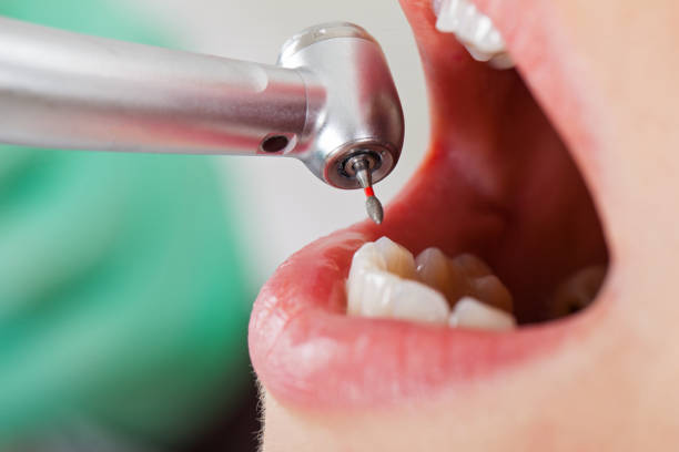 Best Emergency Wisdom Tooth Extraction in Brighton, MI